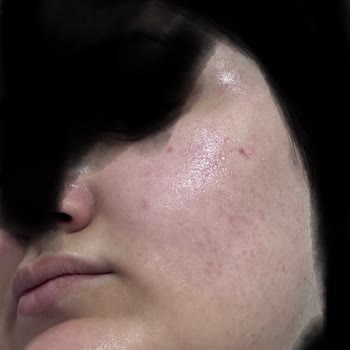 Yüz Tüy Sarartma İşleminden Yanık Ve Kızarıklık: Ücret İadesi Talebi