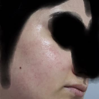 Yüz Tüy Sarartma İşleminden Yanık Ve Kızarıklık: Ücret İadesi Talebi