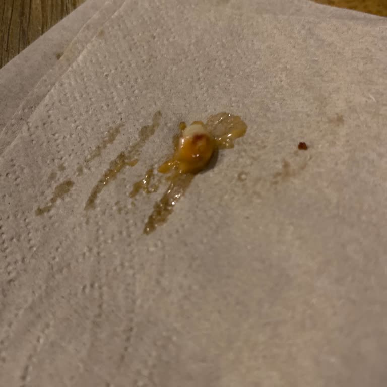 Ankara Taurus AVM'de Tavuk Dünyası'nda Yabancı Madde: Hijyen İhlali Ve Ücret İadesi Talebi