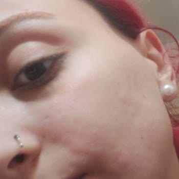 Trendyol’da Aldığım L’Oreal Ürünü Cildimde Şiddetli Kızarıklık Ve Kabarıklık Yarattı, İade Talebi