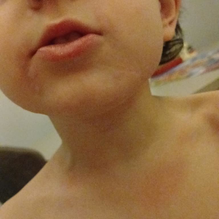 Mini Cheetos Shots Çocuğumda Şiddetli Alerjik Reaksiyon Oluşturdu