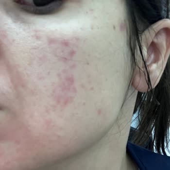 Yanlış Ürün Tavsiyesi Yüzümde Egzama Oluşturdu İade Ve Değişim Talebi