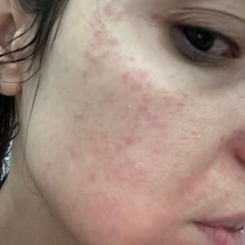 Yanlış Ürün Tavsiyesi Yüzümde Egzama Oluşturdu İade Ve Değişim Talebi