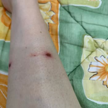 Bershka Ayakkabısı İlk Kullanımda Deride Derin Yara Açtı Ve Şiddetli Ağrıya Sebep Oldu