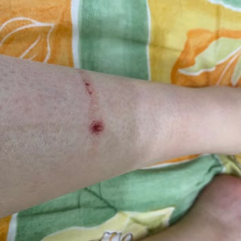 Bershka Ayakkabısı İlk Kullanımda Deride Derin Yara Açtı Ve Şiddetli Ağrıya Sebep Oldu