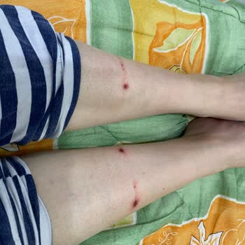 Bershka Ayakkabısı İlk Kullanımda Deride Derin Yara Açtı Ve Şiddetli Ağrıya Sebep Oldu