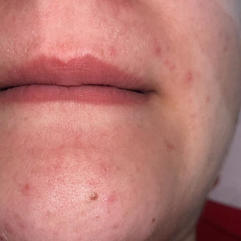 Hassas Cilt İçin Satılan Ağda Bantı Şiddetli Reaksiyon Oluşturdu