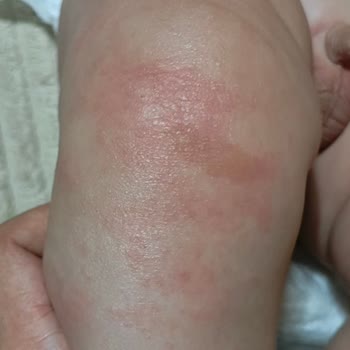 Mustela Stelatopia Kreminin Bebek Cildinde Alerjik Reaksiyon Ve Tazminat Talebi