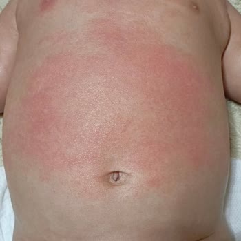 Mustela Stelatopia Kreminin Bebek Cildinde Alerjik Reaksiyon Ve Tazminat Talebi