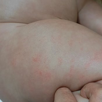 Mustela Stelatopia Kreminin Bebek Cildinde Alerjik Reaksiyon Ve Tazminat Talebi