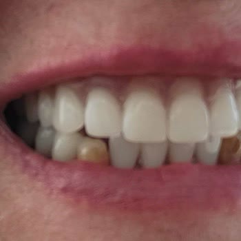 Teslim Edilmeyen Protez Ve Implantlar İçin 40.000 TL Ve 2.000 Euro İade Talebi