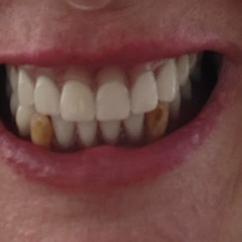 Teslim Edilmeyen Protez Ve Implantlar İçin 40.000 TL Ve 2.000 Euro İade Talebi