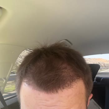 Özel Akl Polikliniği Yanıltıcı Greft Sayısı ve Düğün Öncesi Saç Kıtlığı