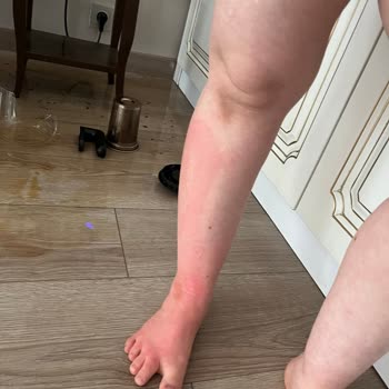 Tefal Çay Makinesi Kulpunun Kırılmasıyla Çocuğa Yanık, Tazmin Ve Güvenlik İncelemesi Talebi