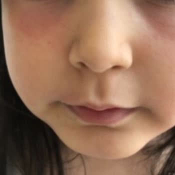 Bepanthol Derma Krem Çocuğumun Yüzünde Şiddetli Alerjik Reaksiyon Yaratmış