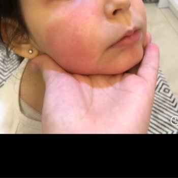 Bepanthol Derma Krem Çocuğumun Yüzünde Şiddetli Alerjik Reaksiyon Yaratmış