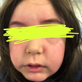 Bepanthol Derma Krem Çocuğumun Yüzünde Şiddetli Alerjik Reaksiyon Yaratmış