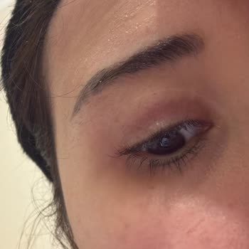 İz Olmayacağı Söylenen Göz Kapağı Ameliyatı Sonrası İz Ve Lekelere Ve Ücret Talebine Karşı Şikayet