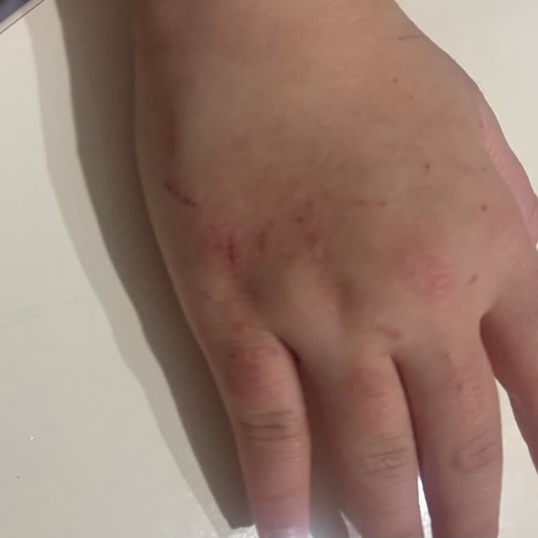 Activex Antibakteriyel Sabunun Cilt Tahrişi Ve Egzama Belirtileri