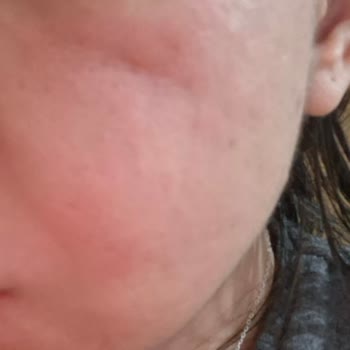 Dermorise Beauty Bakım Diye Yüzümü Mahvetti