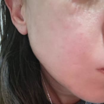 Dermorise Beauty Bakım Diye Yüzümü Mahvetti