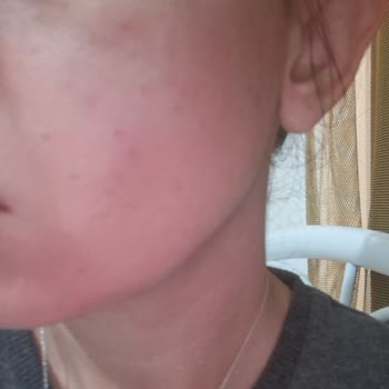 Dermorise Beauty Bakım Diye Yüzümü Mahvetti