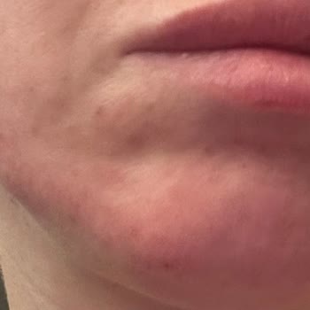 Advanced Night Repair Kremi Kullanımında Şiddetli Cilt Tahrişi Ve Ücret İadesi Talebi