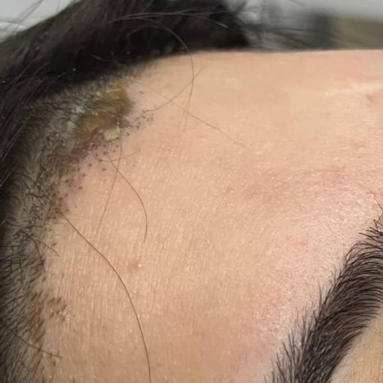 Alnında Yanık Oluşan Kızım İçin 1000 TL İade Talebi