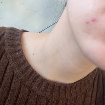 Missha BB Kremi Ciltte Şiddetli Sivilcelenme Ve Yağ Bezesi Oluşturdu, İade Talebi