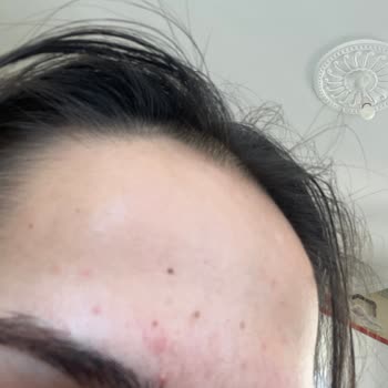 Missha BB Kremi Ciltte Şiddetli Sivilcelenme Ve Yağ Bezesi Oluşturdu, İade Talebi