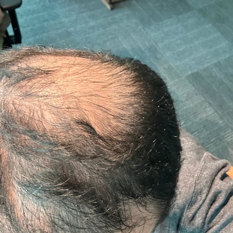 Gold City Hair’in Çözüm Odaklı Yaklaşımı Ve Değerli Hastasına Verdiği Destek