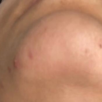 Cilt bakım ürününün yan etkileri ve iade talebi