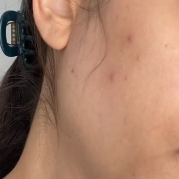 Cilt bakım ürününün yan etkileri ve iade talebi