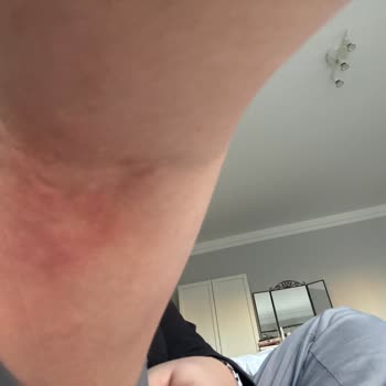 Apikoğlu Pastırması Alerjik Reaksiyonuna Karşı İade Ve Tazminat Talebi