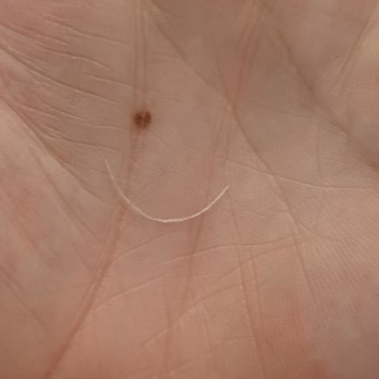 Burger King Burgerinde Plastik Parça Bulunması Ve Boğazıma Takılması