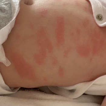 Bebekte Şiddetli Alerjik Reaksiyon Mustela Stelatopia Kremi Güveni Sarsıyor