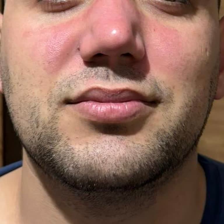 Yves Rocher Pure Menthe Peeling'le Burunda Şiddetli Yanma Ve Kızarıklık