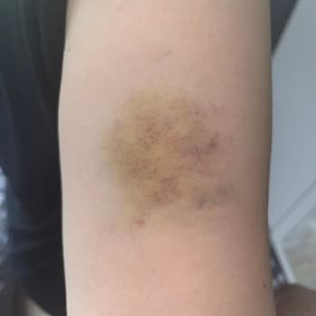 Bursa Orhangazi Şubesinde Erzak Dolabının Devrilmesi Sonrası Ciddi Yaralanma Ve Maddi Zarar Talebi