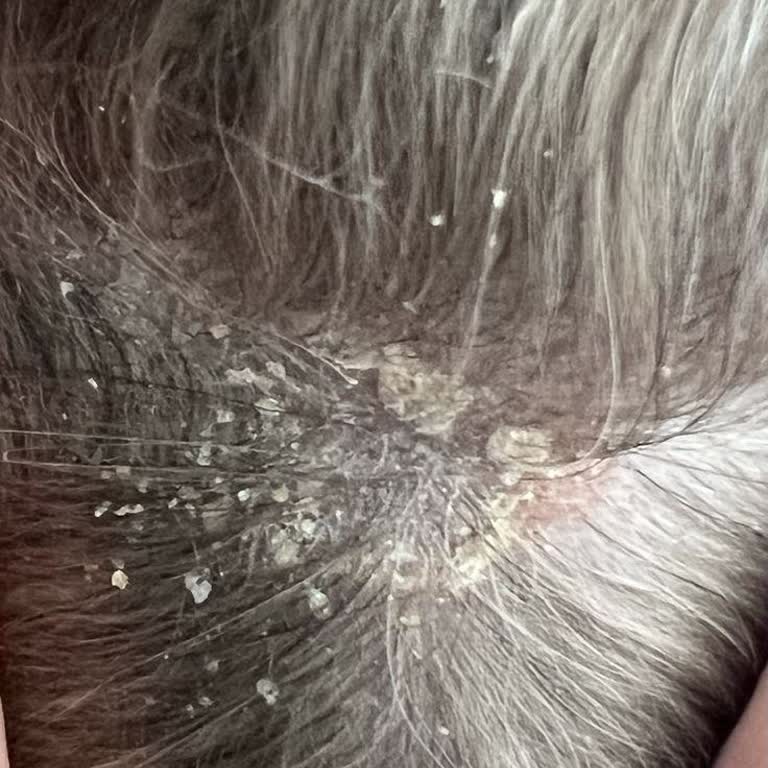 Saç Derisinde Şiddetli Kaşıntı Ve Kabuklanma Yaratan Duru Nem Bombası Şampuanı Ve Maddi Zarar