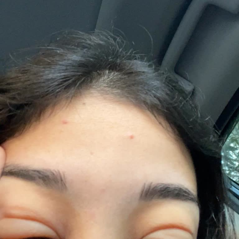 Watsons Maltepe Şubesinde Zorla Satılan Temizleme Suyu Alerjik Göz Şişmesine Yol Açtı