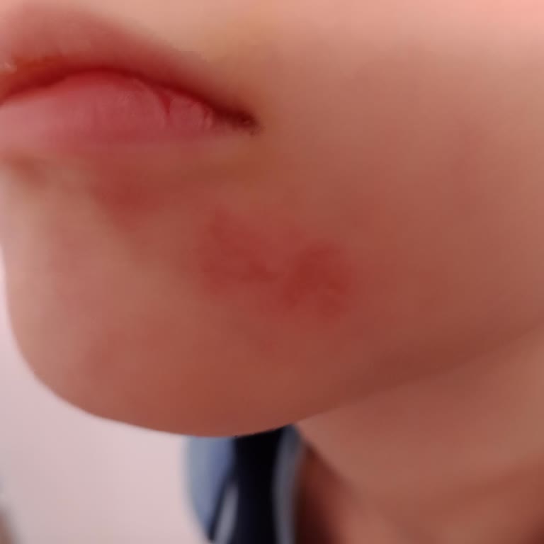 Pedodonti Kliniğinde Çocuğumun Dudak Yaralanması Ve Velinin Dışarı Çıkarılması