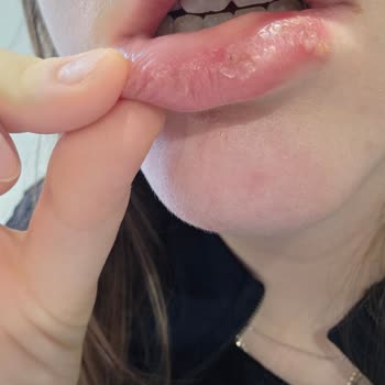 Maybelline Rujunda Alerjik Reaksiyon Ve Şiddetli Ağız Ağrısı