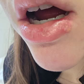 Maybelline Rujunda Alerjik Reaksiyon Ve Şiddetli Ağız Ağrısı