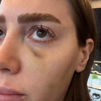 Dilan Polat Estetik Orta Yüz Ve Çene Dolgusu Sonrası Şiddetli Asimetri Ve Kaba Klinik Tutumu