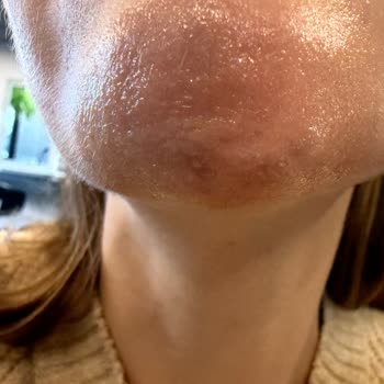 Dilan Polat Estetik Orta Yüz Ve Çene Dolgusu Sonrası Şiddetli Asimetri Ve Kaba Klinik Tutumu