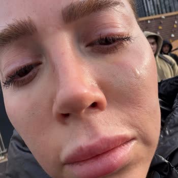 Dilan Polat Estetik Orta Yüz Ve Çene Dolgusu Sonrası Şiddetli Asimetri Ve Kaba Klinik Tutumu