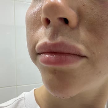 Dilan Polat Estetik Orta Yüz Ve Çene Dolgusu Sonrası Şiddetli Asimetri Ve Kaba Klinik Tutumu