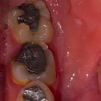 Aceleci Kanal Ve Dolgu Tedavisi Sonrası 1,5 Yıllık Ağız Sağlığı Mağduriyeti