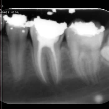 Aceleci Kanal Ve Dolgu Tedavisi Sonrası 1,5 Yıllık Ağız Sağlığı Mağduriyeti