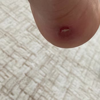 Sağlık Sorunu Yaratacak Kusurlu Adidas Ayakkabı Ve İlgisiz Müşteri Hizmetleri